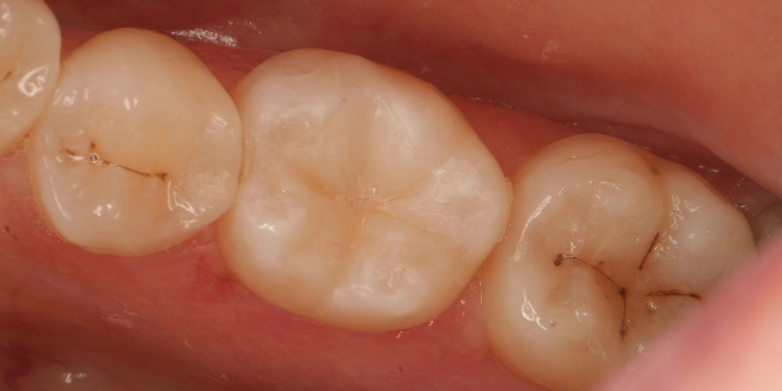 http://White%20fillings%20after