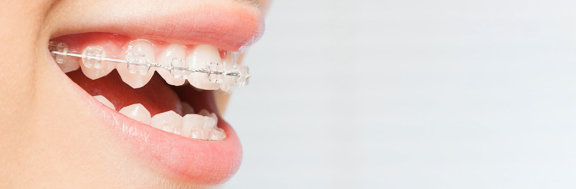 Orthodontic braces